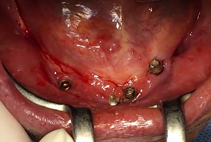 Retrabalho Inferior com Risco de Fratura Mandibular: Uma Abordagem com Implantes Curtos e Carregamento Tardio – Implante Lite