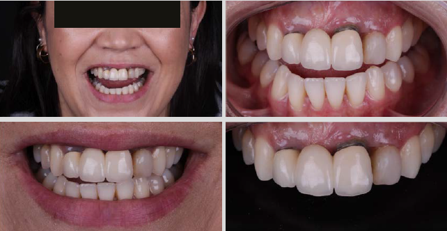 IMPLANTE IMEDIATO EM ÁREA ESTÉTICA (11 E 21), CONJUGADO COM COROAS SOBRE DENTES EM 12 E 22. – Implante Epikut S