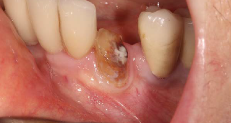 INSTALAÇÃO IMEDIATA DO IMPLANTE EPIKUT S EM REGIÃO DE CANINO INFERIOR COM COMPROMETIMENTO PERIODONTAL: RELATO DE CASO