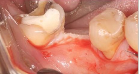 REABILITAÇÃO COM IMPLANTE UNITÁRIO EM REGIÃO POSTERIOR MANDIBULAR – Implante Epikut S