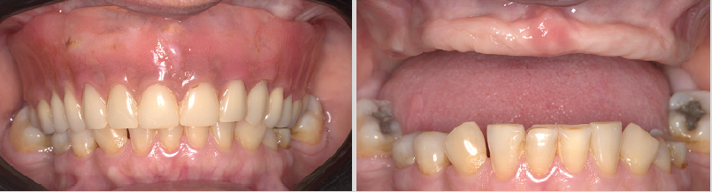 REABILITAÇÃO BEYOND FULL ARCH CARGA IMEDIATA – Implantes Zygomatic Plus e Epikut S PTG Plus