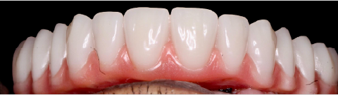 BEYOND FULL ARCH – REABILITAÇÕES MAXILAS ATRÓFICAS: IMPLANTES EPIKUT PLUS, EPIKUT LONG PLUS E EPIKUT S PTG PLUS