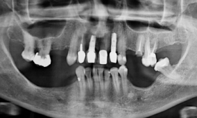 REABILITAÇÃO COMPLEXA EM MAXILA – IMPLANTES IMEDIATOS EM ÁREAS DE EXODONTIAS E EXPLANTAÇÕES – Implante Epikut S PTG Plus