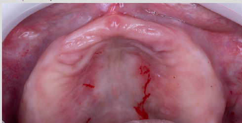 REABILITAÇÃO DE MAXILA ATRÓFICA – Implantes Epikut S PTG Plus e Zygomatic Plus
