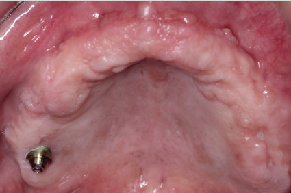 NOVOS IMPLANTES ZIGOMÁTICOS PARA RESOLUÇÃO DE INSUCESSO DE IMPLANTES CONVENCIONAIS E LEVANTAMENTO DE SEIO MAXILAR – Implante Zygomatic Plus