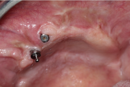 NOVOS IMPLANTES ZIGOMÁTICOS PARA RESOLUÇÃO DE INSUCESSO DE IMPLANTES CONVENCIONAIS E LEVANTAMENTO DE SEIO MAXILAR – Implante Zygomatic Plus