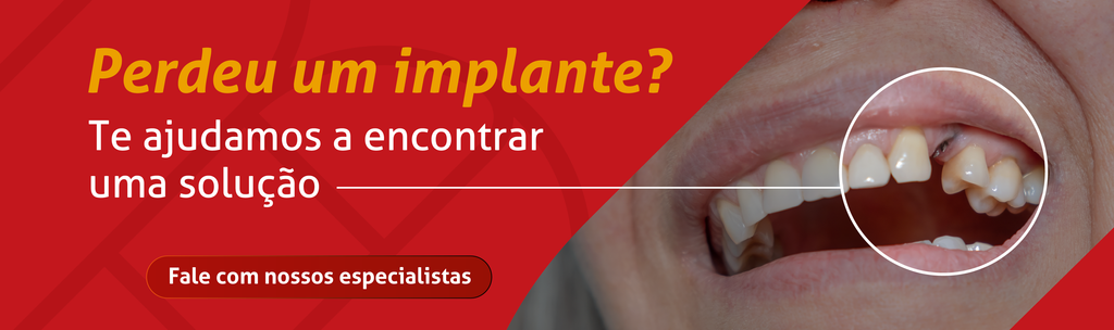 Perdeu um implante? Te ajudamos a encontrar uma solução
CTA: Fale com nossos especialistas