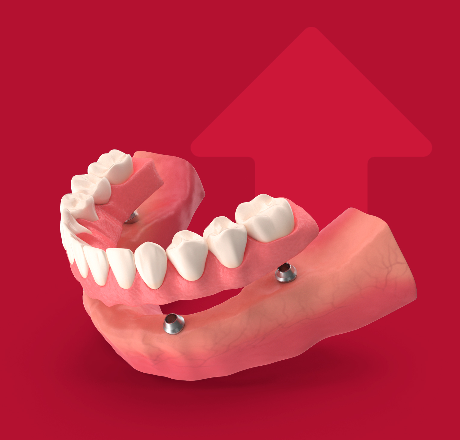 Cicatrização óssea acelerada 