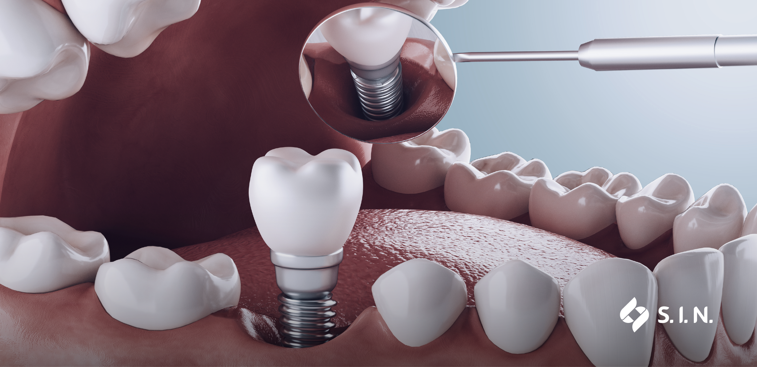 When should you include immediate loading in your Patient’s treatment plan?