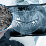 S.I.N. Superficie Plus HAnano: la ciencia detrás de la osteointegración acelerada y el éxito clínico