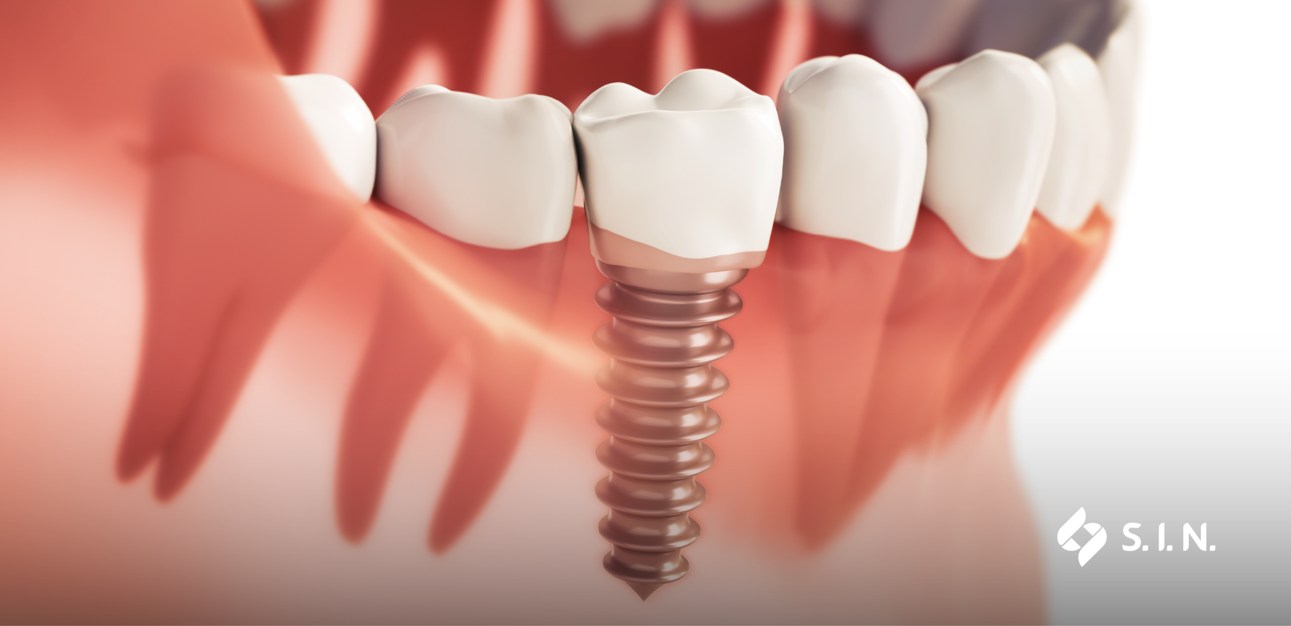 Pérdida de implantes dentales: causas y prevención clínica